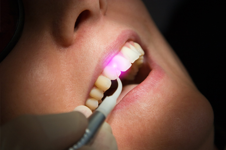 Laser Dentistry - Dental Office Boynton Beach